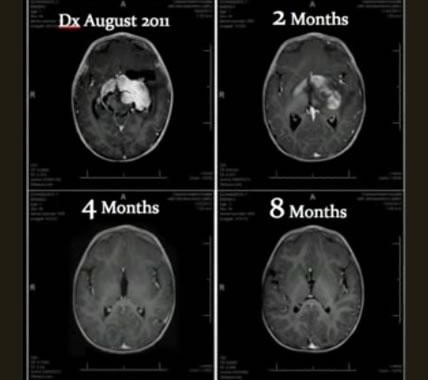 Cannabis-Oil-Cures-8-Month-Old-Infant-of-Cancer-Dissolving-Large-Inoperable-Tumor-In-8-Months-Scans