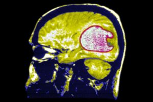 cell phone brain tumor