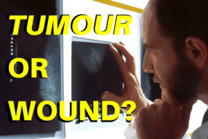 Tumor or wound x-ray - endalldisease.com